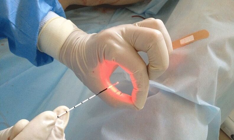 prostatiidi laserravi